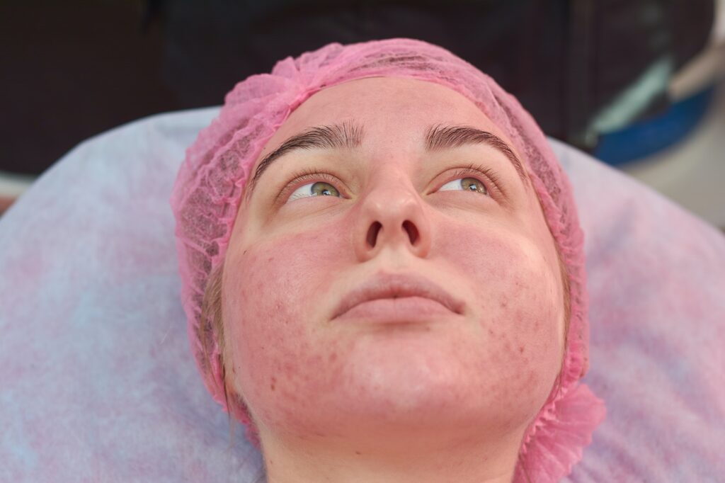 Face of young woman, acne